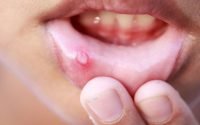 Ulser Mulut Petanda Awal Kanser. 10 Cara Cegah Dari Terus Merebak Teruk